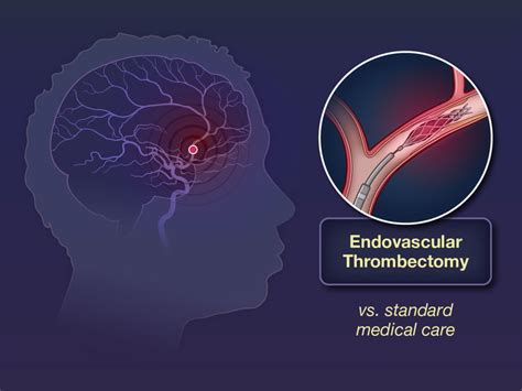 Trial of Thrombectomy for Stroke with a Large Infarct of 